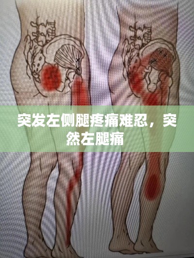 突发左侧腿疼痛难忍,突然左腿痛